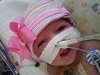 В США родилась девочка с сердцем вне тела